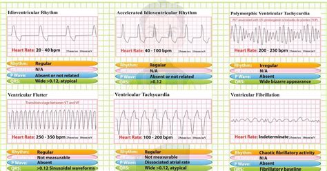 Idioventricular Rhythm Accelerated Idioventricular Rhythm Accelerated ...