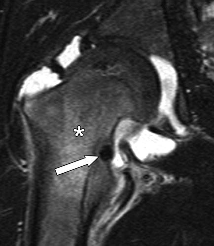 Osteoid Osteoma Femur