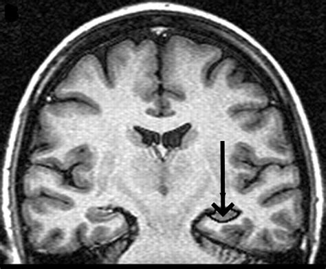 Brain atrophy - Neuromedia