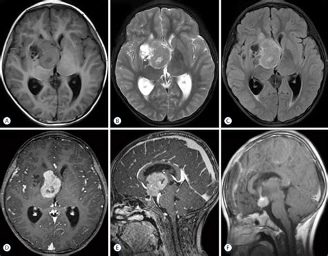 Basal Ganglia Stroke Mri - vrogue.co