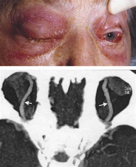 Cavernous sinus thrombosis - The Lancet