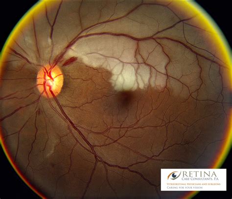 Central Retinal Artery Occlusion Anatomy