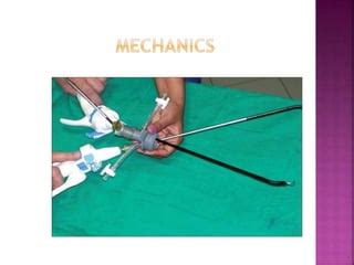 SILS - SINGLE INCISION LAPAROSCOPIC SURGERY | PPT