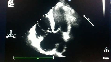 Echocardiogram - ostium primum atrial septal defect - YouTube