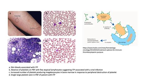 Immune Thrombocytopenia Itp Blood Disorders Msd