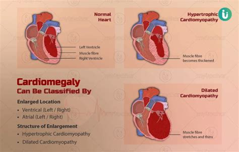 Enlarged Heart symptoms, causes, treatment, medicine, prevention, diagnosis