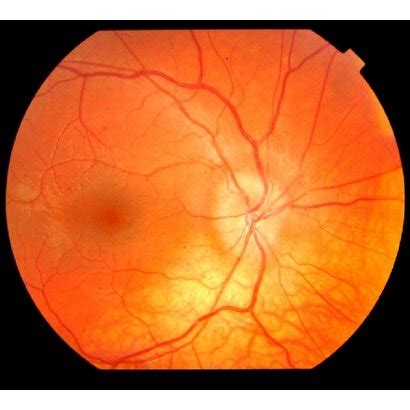 ((a), (b)) Bilateral optic disc edema on initial examination. There is ...