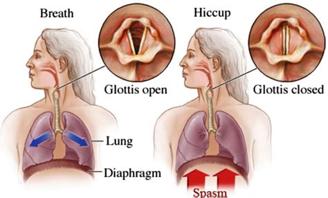 Hiccups - Causes, Symptoms, Diagnosis And Best Treatment