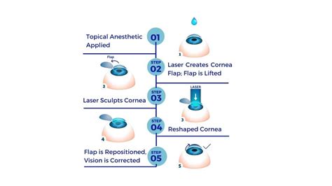 Lasik Eye Surgery Recovery Time