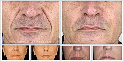 Nasolabial Folds Surgery - Remove Deep Laugh Lines Around The Mouth ...