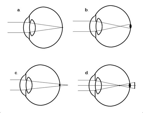 Refractive errors. In emmetropia (a) light focuses onto the retina. In ...