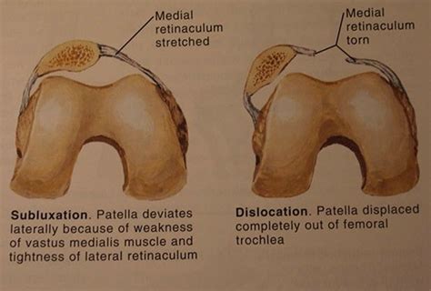 Patella Dislocation | Singapore Sports & Orthopaedic Surgeon