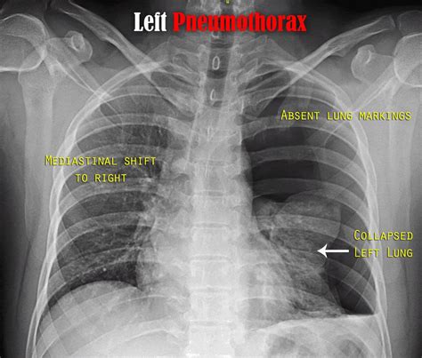 Chest X Ray Mild Pneumothorax