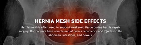 HERNIA MESH SIDE EFFECTS – Holistic Hernia Remediation