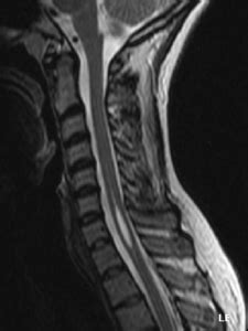 Syringomyelia - Physiopedia