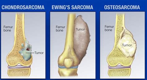 Sarcoma Cancer Types, Symptoms, Causes, Treatment. :: Health Reactive ...