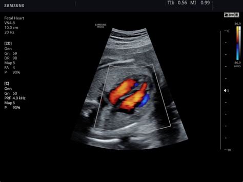 Ultrasound images • Fetal heart, color doppler, echogramm №787