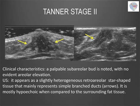 Breast Development - Tanner Stage II Sonography, Tanner, Star Shape ...