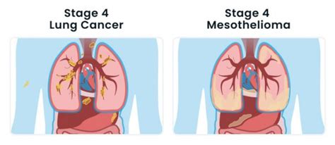 Pleural Mesothelioma vs. Lung Cancer: Diagnosis & Treatment