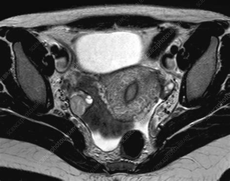 Normal female pelvis, MRI - Stock Image - C026/9011 - Science Photo Library