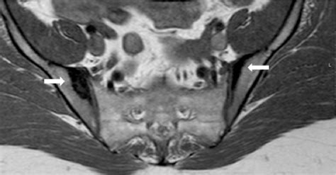 Sacroiliitis – Findings on Conventional Radiography, CT and MRI studies | Semantic Scholar