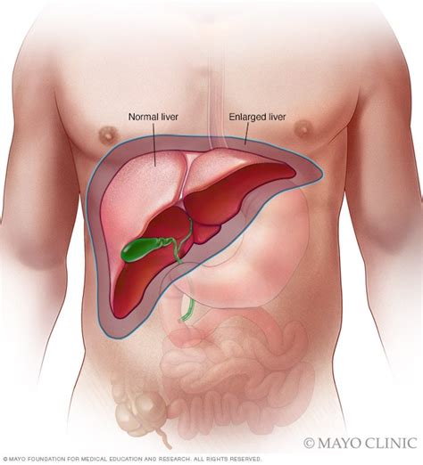 Enlarged liver - Symptoms and causes - Mayo Clinic