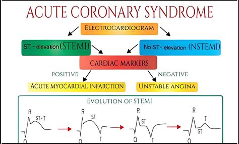 Acute Coronary Syndrome: Causes, Risk Factors, Symptoms, Treatment