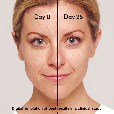 White Spots On Face From Retinol - Printable Templates Protal