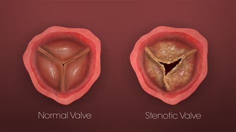 Transcatheter Heart Valves: How they revolutionized heart surgeries