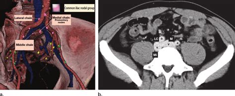 Internal Iliac Lymph Nodes