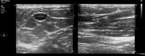 Ultrasound-Guided Cavity Analysis and Vascular Access