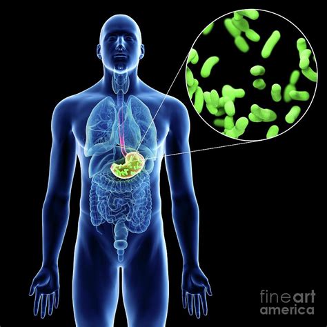 Illustration Of A Man's Stomach Infection Photograph by Sebastian ...