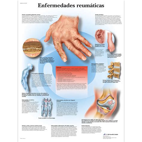 Enfermedades reumáticas - 1001807 - VR3124L - Skeletal System - 3B Scientific