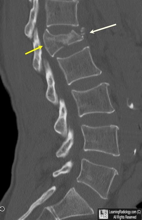 Burst Fracture of Lumbar Spine. Sagittal reconstruction of CT of the ...