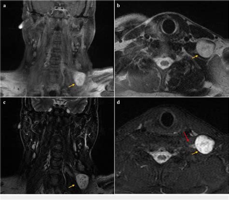 MRI images of the patient's neck The yellow arrow indicates the tumor ...