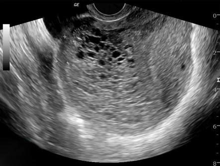 Hydatidiform mole | Radiology Reference Article | Radiopaedia.org