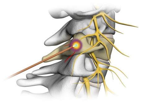 Spine - Cervical Radiculopathy - AOA Orthopedic Specialists