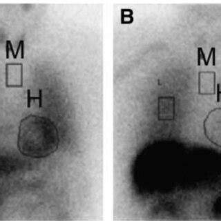 123I-MIBG scintigraphy. Early anterior planar images of myocardial... | Download Scientific Diagram