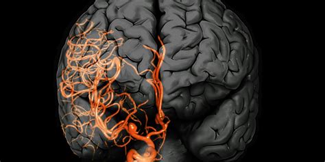 What Causes Brain Aneurysms? They Aren't Always As Sudden As They Seem