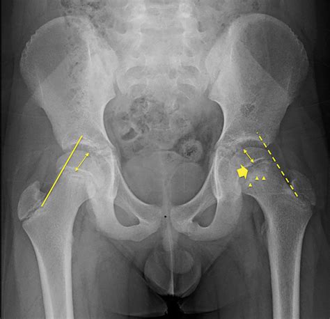 Slipped Capital Femoral Epiphysis