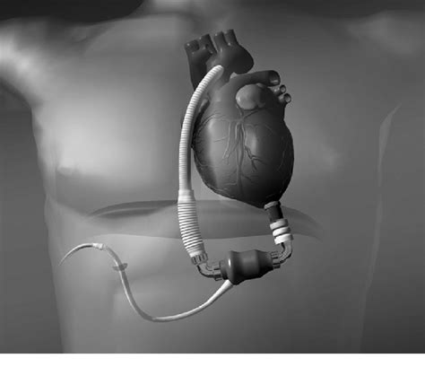 HeartMate ® II left ventricular assist system. (Courtesy of Thoratec ...