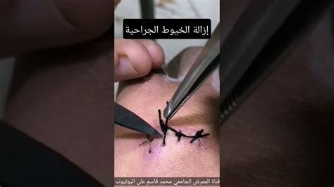 كيفية ازالة الخيوط الجراحية(الغرز الجراحية) | How to Remove Surgical Sutures #shorts #محمد_قاسم ...