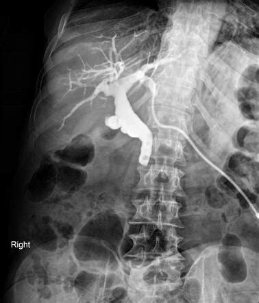 Percutaneous transhepatic cholangiography | Radiology Case | Radiopaedia.org