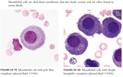 Peritoneal Fluid Cell Count | Hot Sex Picture