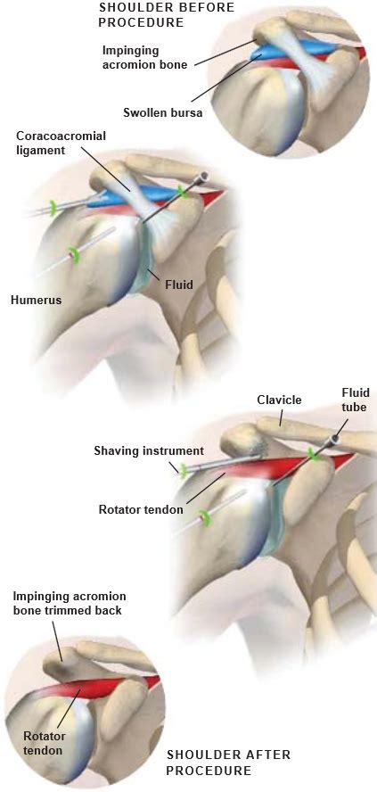 Shoulder Impingement Surgery | Central Coast Orthopedic Medical Group