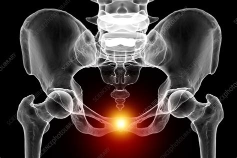 Symphysis pubis dysfunction, illustration - Stock Image - F037/6932 ...