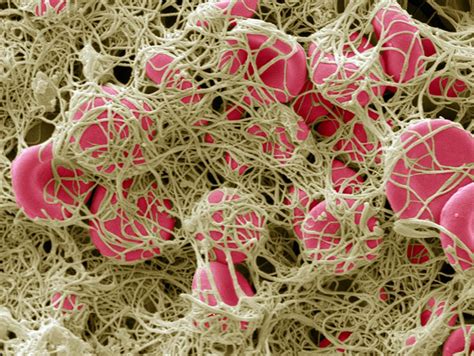 Coronavirus blood-clot mystery intensifies