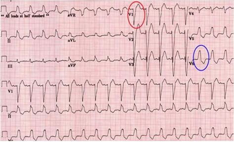 Example of Left Bundle Branch Block (LBBB) [8] | Download Scientific Diagram