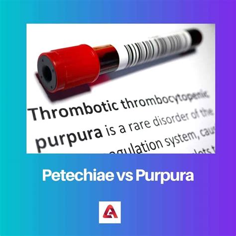 Petechiae vs Purpura: Difference and Comparison