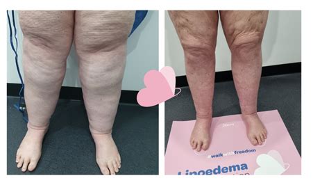 Lipoedema Surgery – Case 16 - Lipoedema Surgical Solution